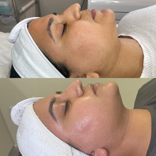 Best Way To Clear Pitted / Boxed Scarring