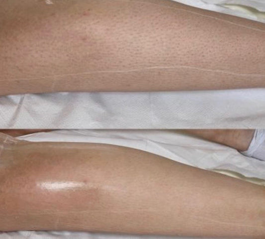 Benefits Of Laser Hair Removal
