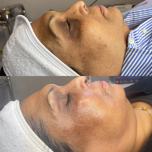 How To Reduce Skin Pigmentation