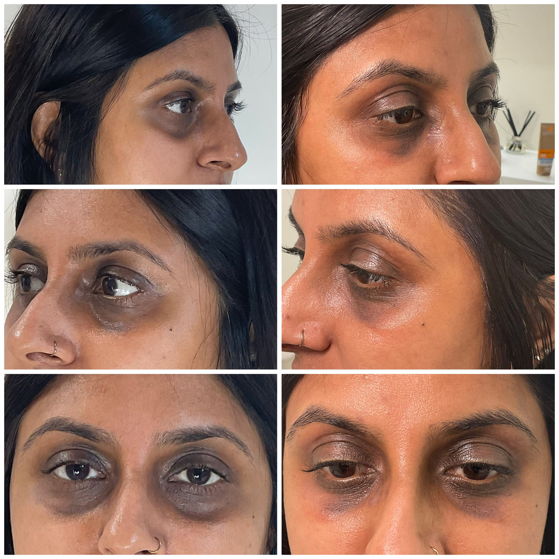 Best Way To Treat Dark Circles 