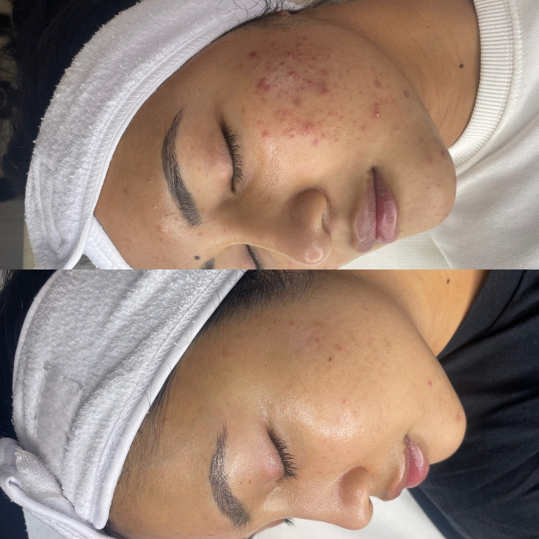 How To Treat Breakouts And Acne